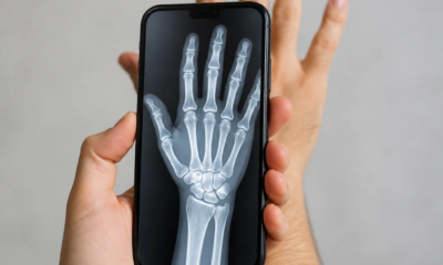 Aplicativo Raio-X: Veja Radiografia dos Ossos